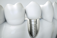 A digital image of a single tooth dental implant surgically put into place between two natural teeth on the lower arch