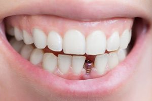 Smile with dental implant