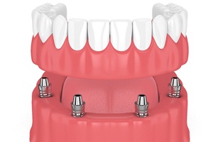 Model of implant denture