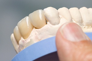 entist holding a model of a mouth with veneers on it