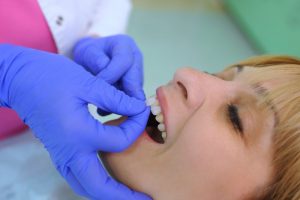 a dentist replacing veneers on a patient