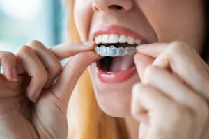 Woman putting Invisalign on. 