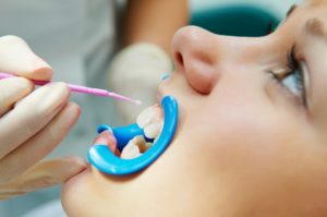 A person receiving teeth whitening.