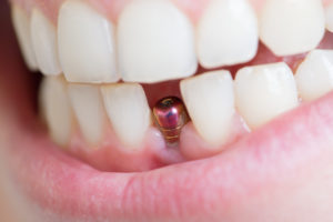 woman smiling showing dental implant