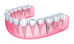 Dental implant embedded in jaw