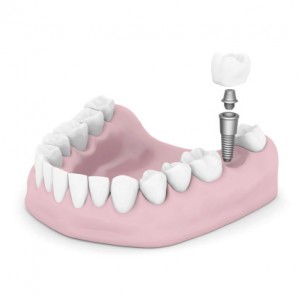 dental implant treatment.