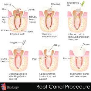 A root canal can save your tooth.