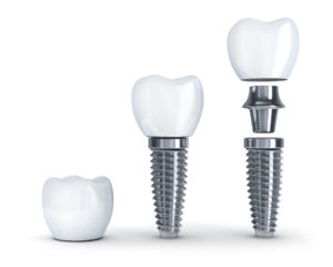 tooth implant dental structure