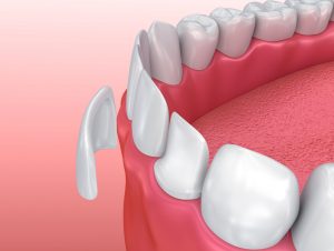 Porcelain veneers in Colliersville cover gaps.