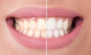 Your dentist for teeth whitening in Collierville.