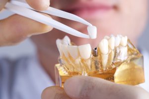 Dental implants in Colliersville are today’s premiere tooth replacement. Read Dr. Joshua Holcomb’s answers to questions about these prosthetics.